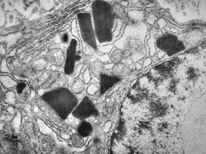M,47y. | tonsillar plasmocytoma - inclusions M,47y. | tonsillar plasmocytoma - inclusions